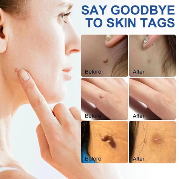 Auto Skin Tags Removal Tool Device with Cleansing Wipes – Safe, Painless Skin Tag Remover Kit