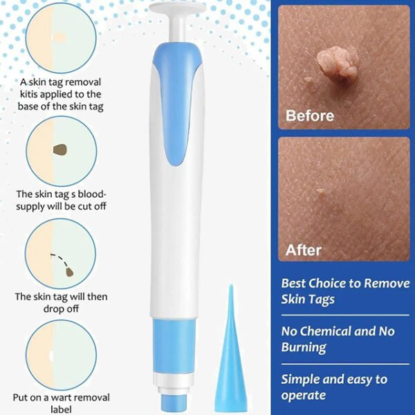 Auto Skin Tags Removal Tool Device with Cleansing Wipes – Safe, Painless Skin Tag Remover Kit